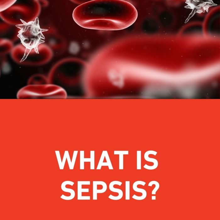 What Most People Get Wrong About Sepsis: The Hidden Danger Behind Common Infections