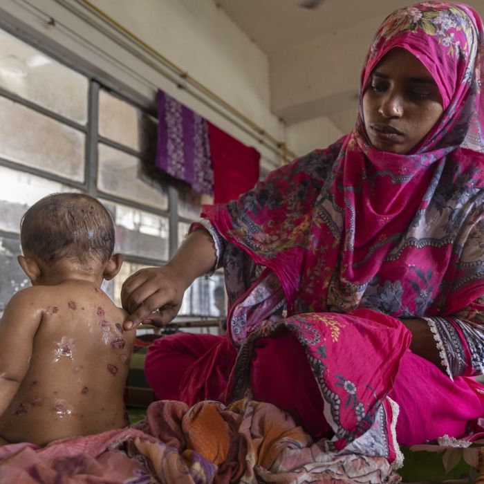 Bangladesh Measles Outbreak: Over 500 Children Dead in a Crisis the World Is Ignoring