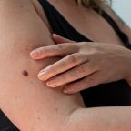 Mind Your Moles: A Complete Guide to Performing a Skin Cancer Self-Exam at Home 5 Mind Your Moles