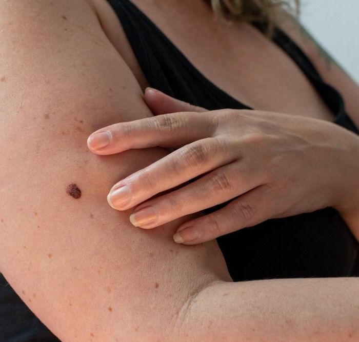 Mind Your Moles: A Complete Guide to Performing a Skin Cancer Self-Exam at Home