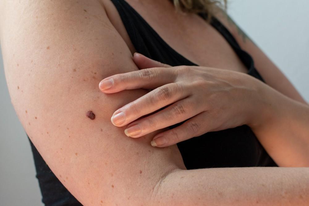 mind-your-moles-a-complete-guide-to-performing-a-skin-cancer-self-exam-at-home