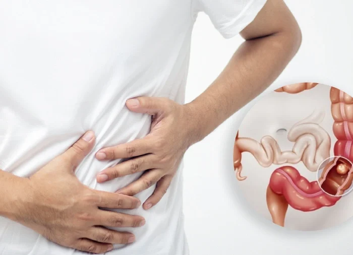 Colon Cancer in Young Adults