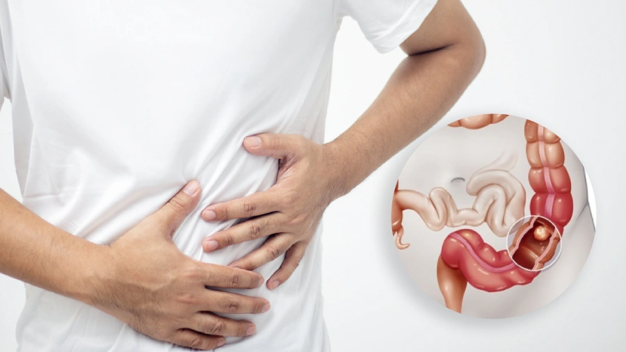 colon-cancer-in-young-adults