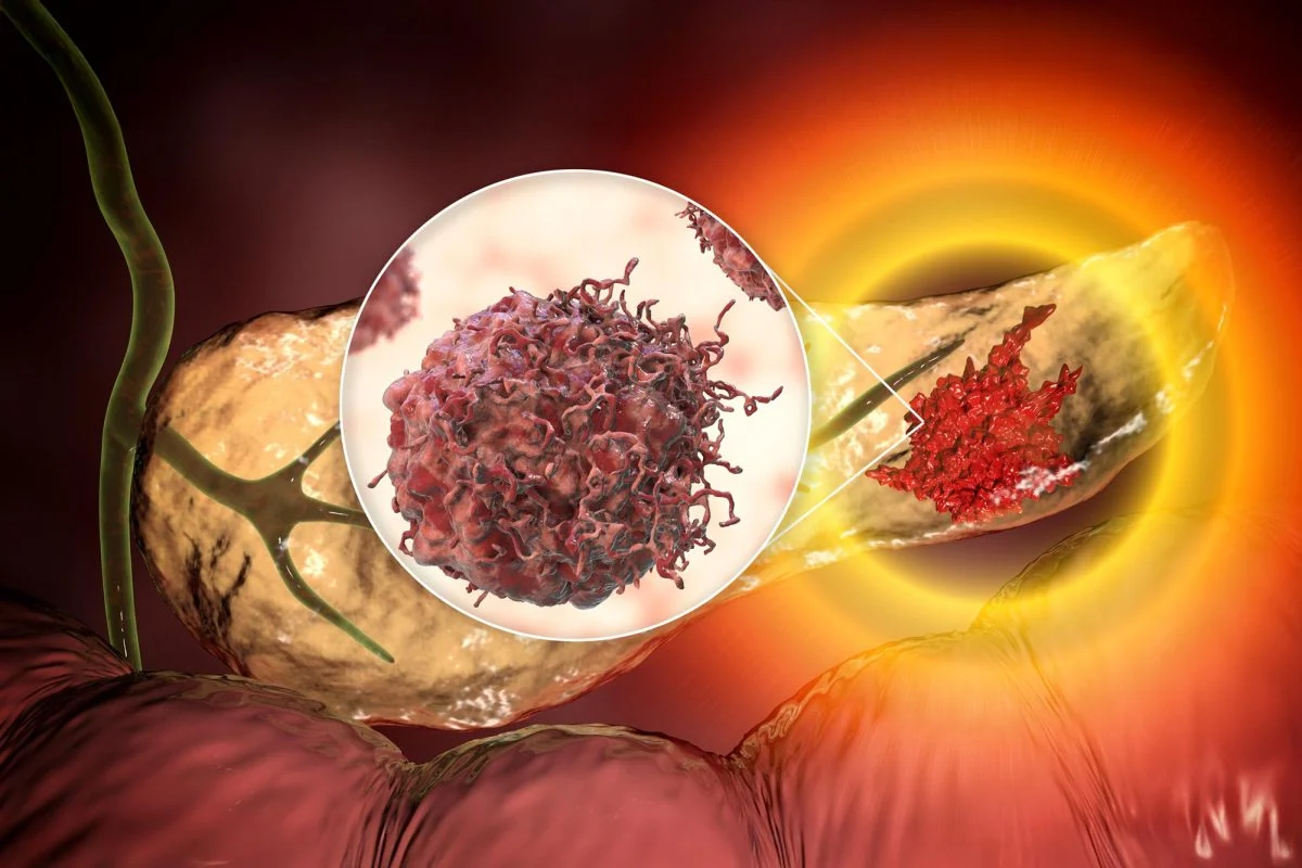 ai-breakthrough-new-tool-detects-deadliest-cancer-years-before-tumors-appear