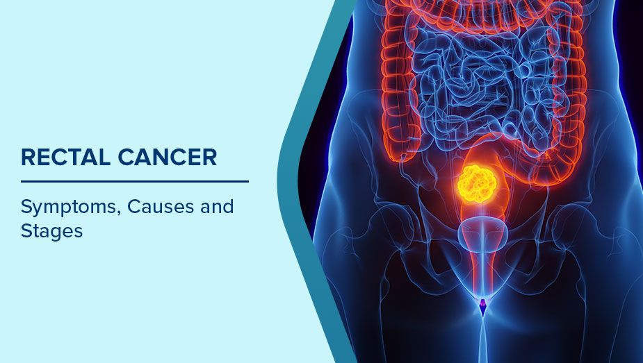 rectal-cancer-warning-signs-every-young-adult-should-know-as-cases-surge-in-30s-and-40s