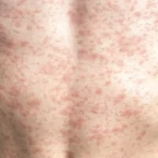 Possible Measles Exposure