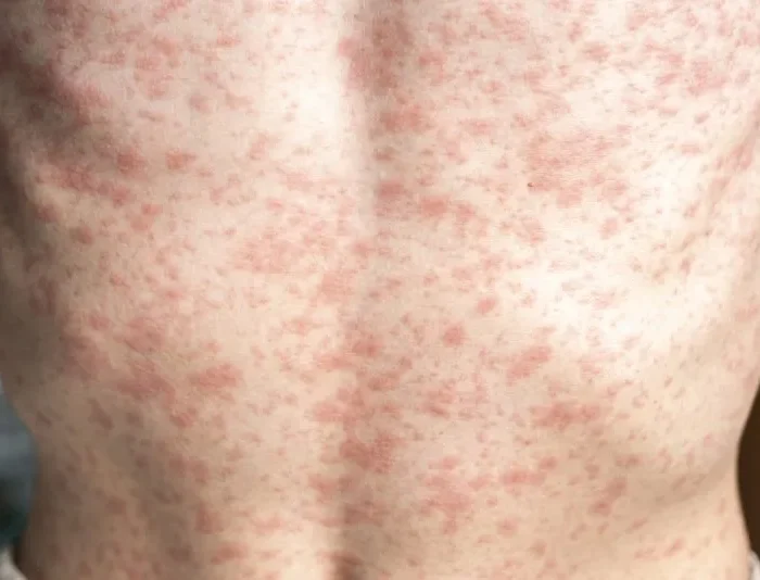 Possible Measles Exposure Reported at Three Bay Area Locations