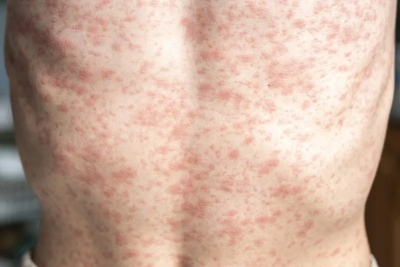 possible-measles-exposure-reported-at-three-bay-area-locations