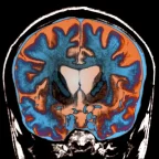 Fight to Cure Huntington's Disease