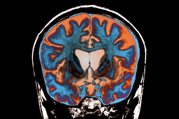a-scientists-race-against-his-own-brain-the-fight-to-cure-huntingtons-disease