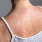 US Measles Cases Top 2,000 Again