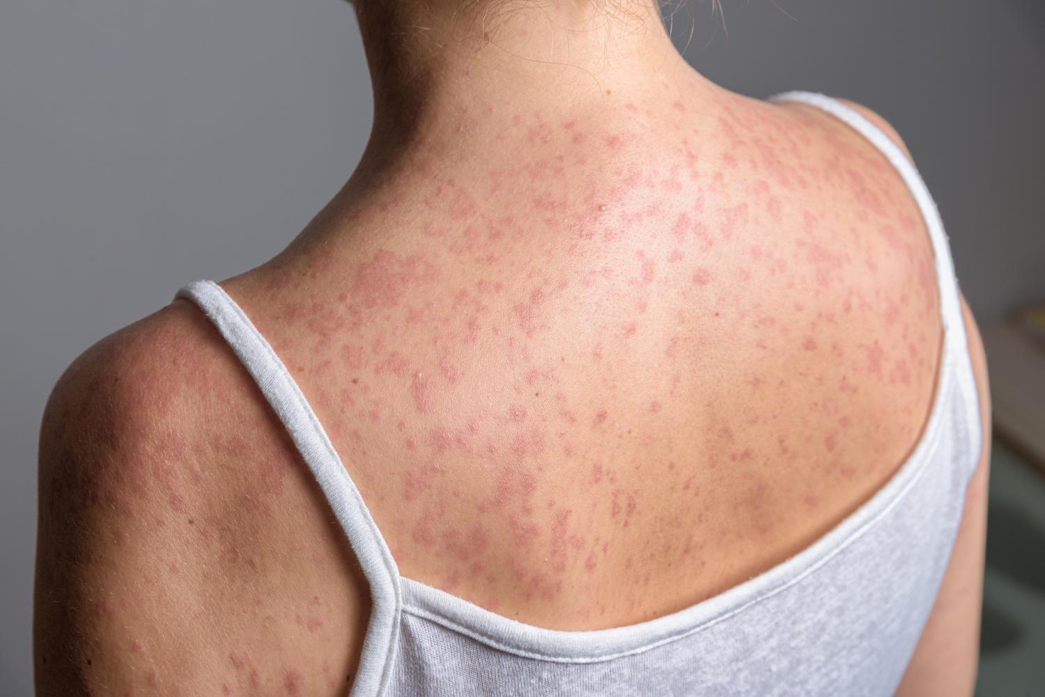 us-measles-cases-top-2000-again-putting-the-nations-elimination-status-at-risk
