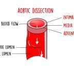 Aortic Dissection Explained