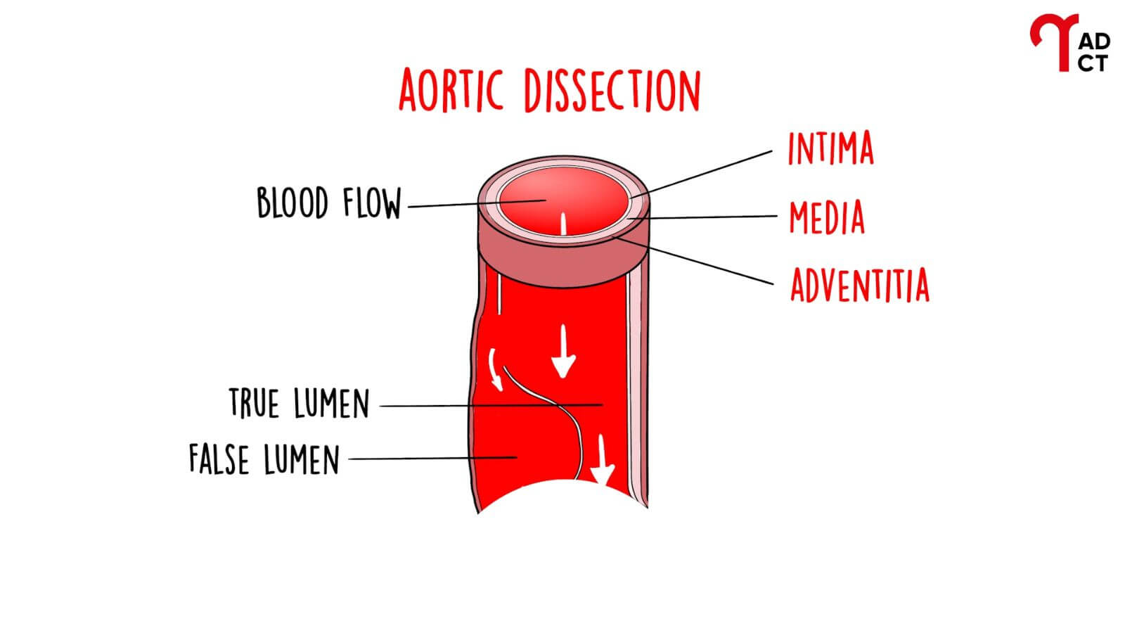 aortic-dissection-explained-the-silent-killer-behind-lindsey-grahams-sudden-death