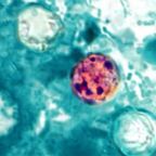 Cyclosporiasis Outbreak Hits Michigan