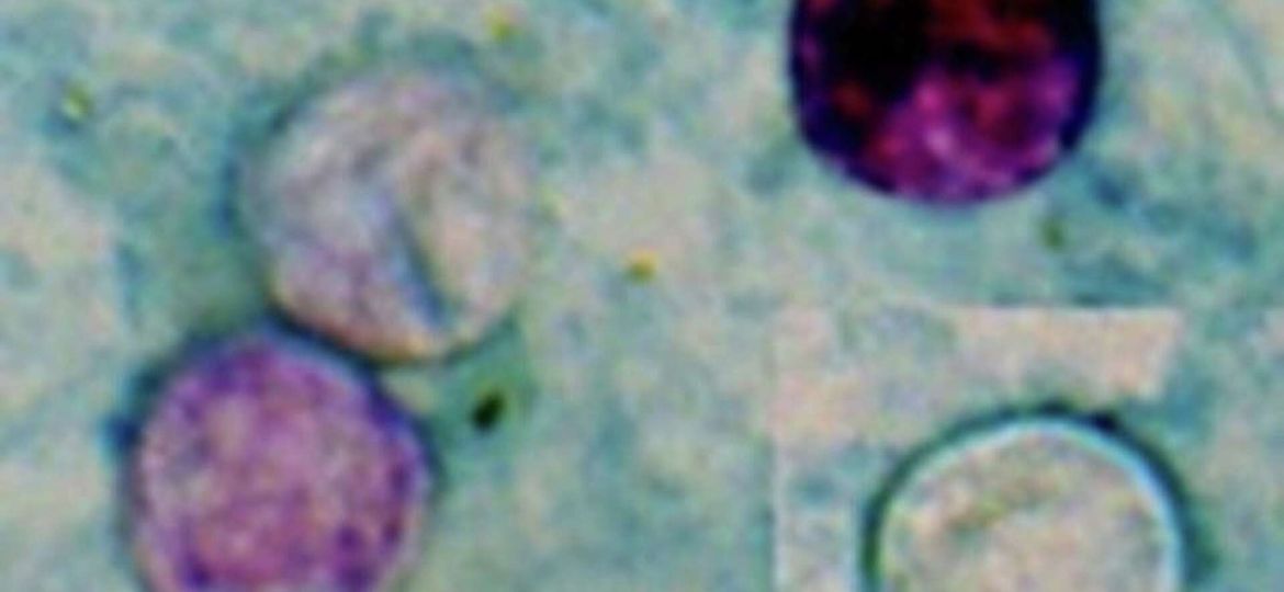 Cyclospora Parasite Outbreak
