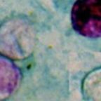 Cyclospora Parasite Outbreak: What You Need to Know About the Stomach Illness Spreading Across the US 9 Cyclospora Parasite Outbreak