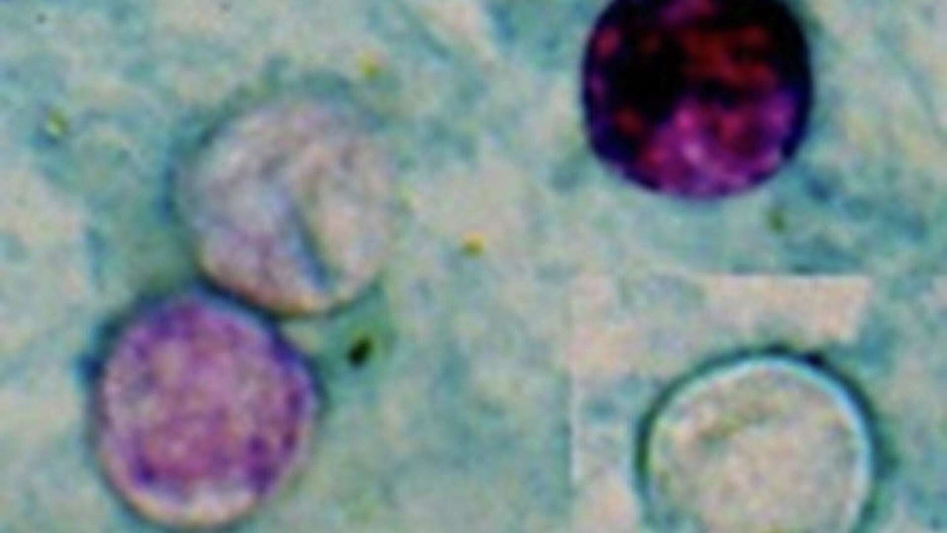 cyclospora-parasite-outbreak-what-you-need-to-know-about-the-stomach-illness-spreading-across-the-us