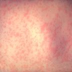 Measles Outbreak Tests Southwestern