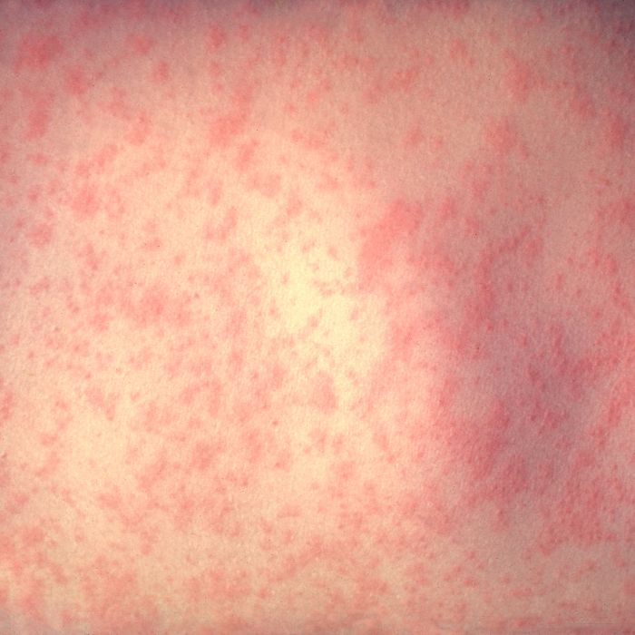 From Two Cases to Fifteen in Days: A Measles Outbreak Tests Southwestern Wisconsin