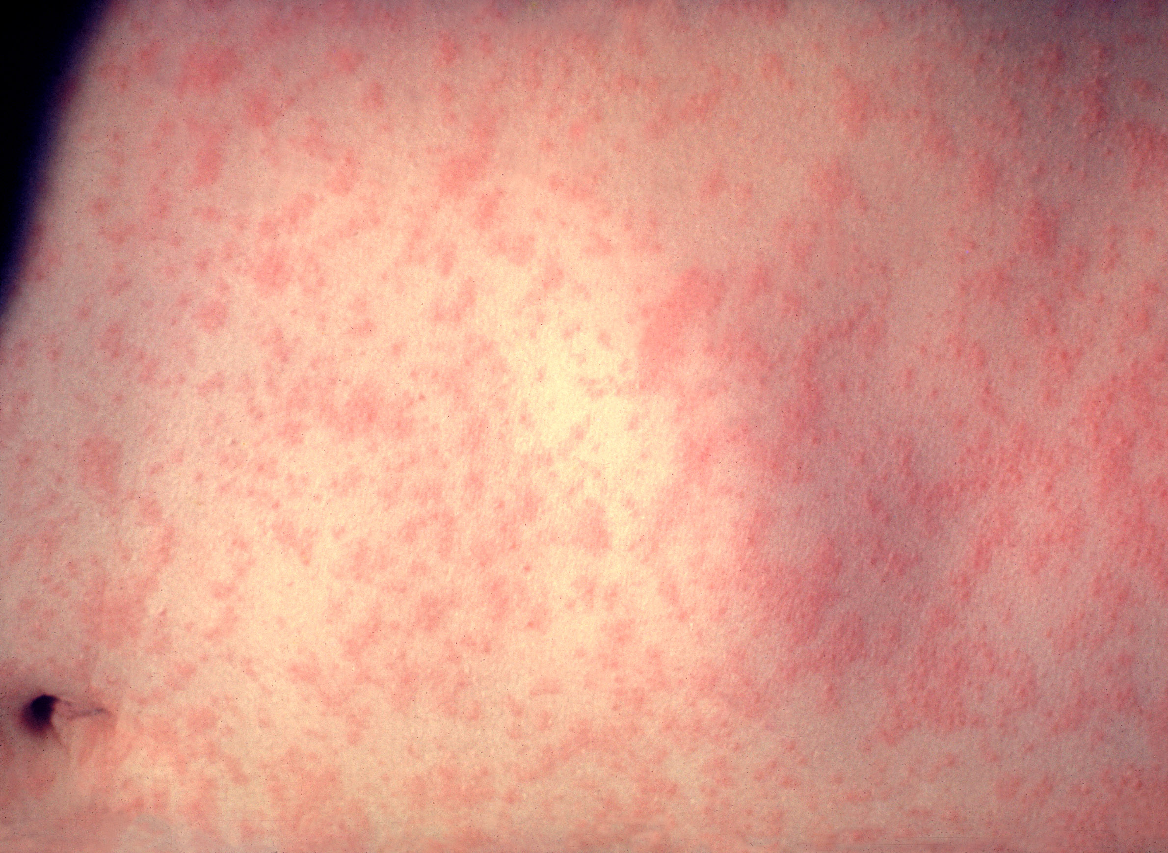 from-two-cases-to-fifteen-in-days-a-measles-outbreak-tests-southwestern-wisconsin