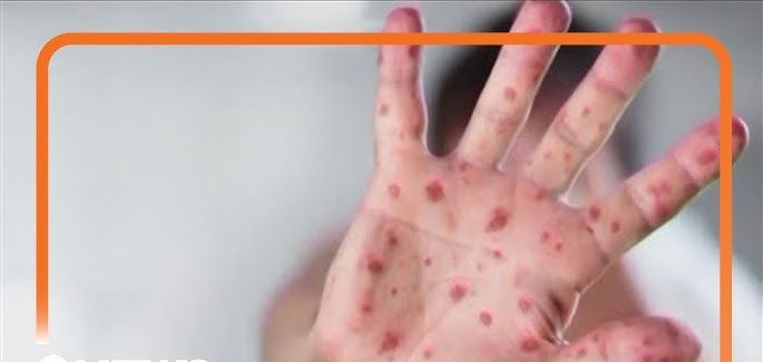 Measles Exposure at Portland Children’s Hospital Adds to America’s Worst Year Since the 1990s
