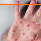 Measles Exposure at Portland Children's Hospital