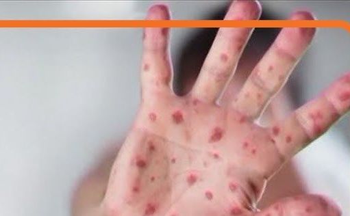 measles-exposure-at-portland-childrens-hospital-adds-to-americas-worst-year-since-the-1990s